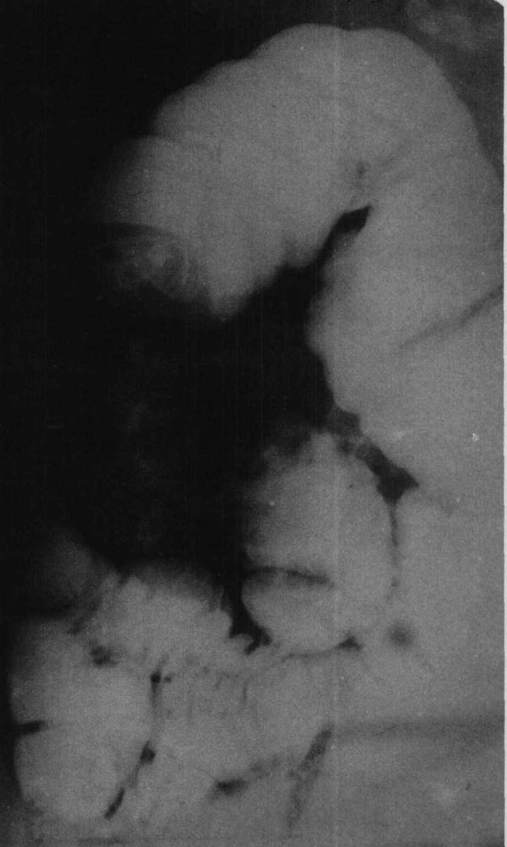 3.結(jié)腸癌